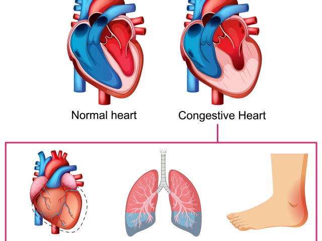 Understanding the critical difference between Heart Attack and Heart Failure