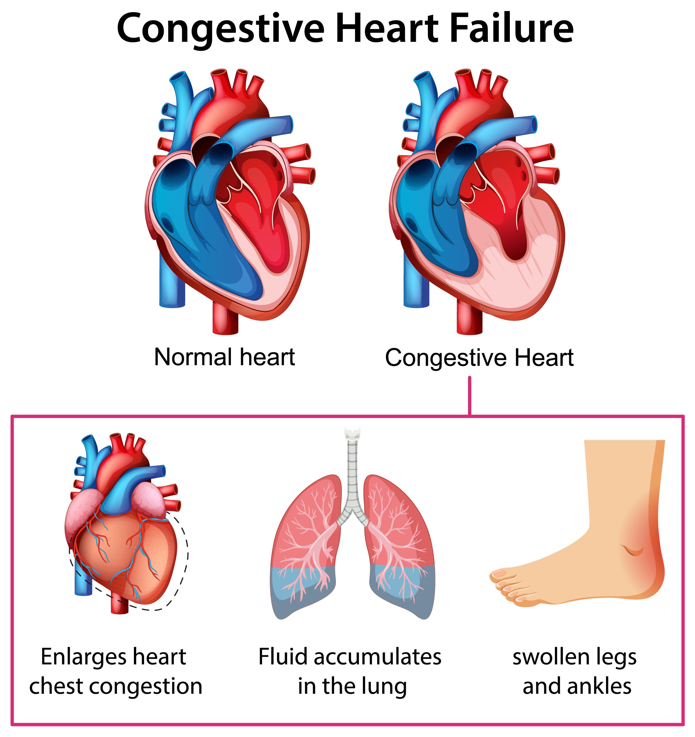 Heart Failure